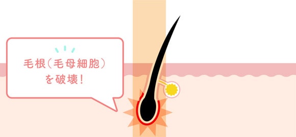 毛根（毛母細胞）を破壊